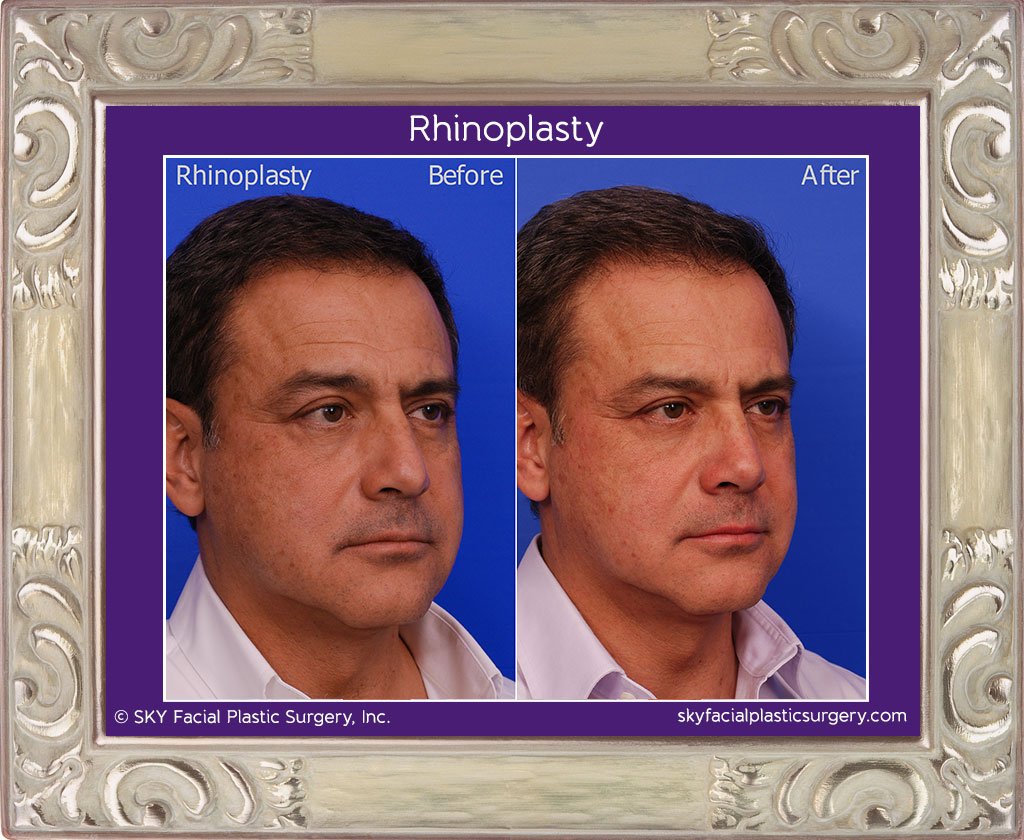 SKY-Facial-Plastic-Surgery-Rhinoplasty-16D.jpg