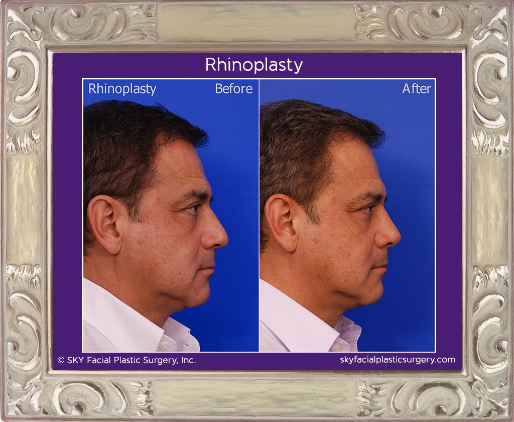SKY-Facial-Plastic-Surgery-Rhinoplasty-16E.jpg