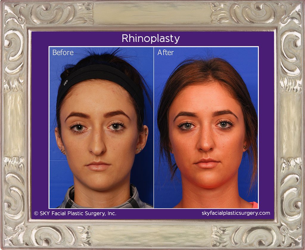 SKY-Facial-Plastic-Surgery-Rhinoplasty-17A.jpg