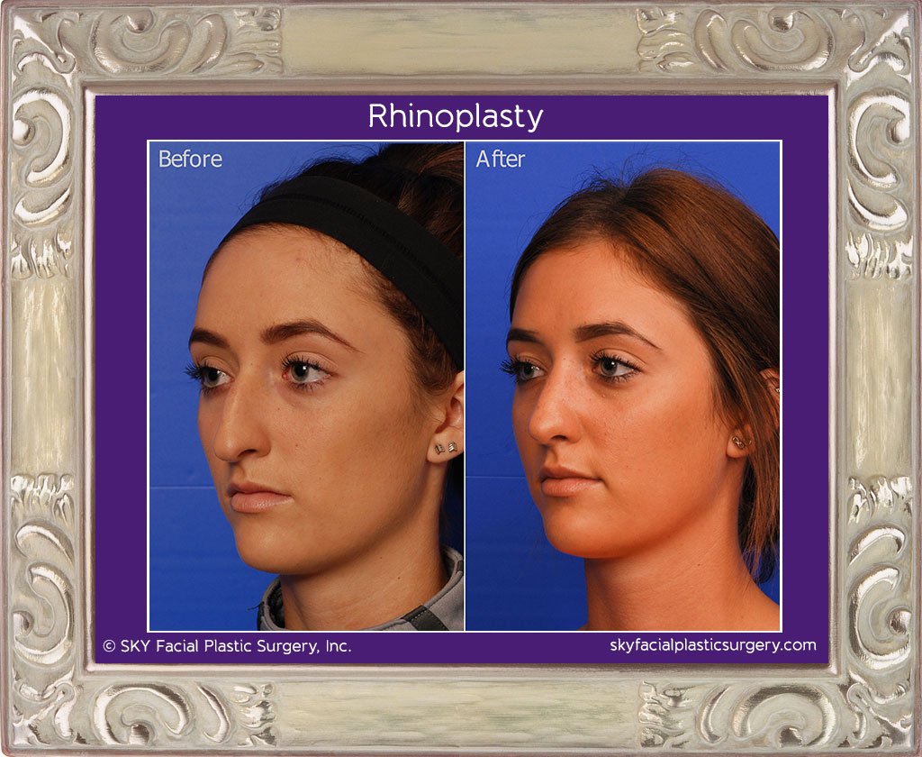 SKY-Facial-Plastic-Surgery-Rhinoplasty-17C.jpg