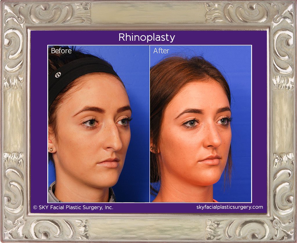 SKY-Facial-Plastic-Surgery-Rhinoplasty-17D.jpg