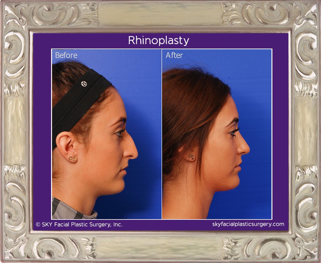 SKY-Facial-Plastic-Surgery-Rhinoplasty-17E.jpg