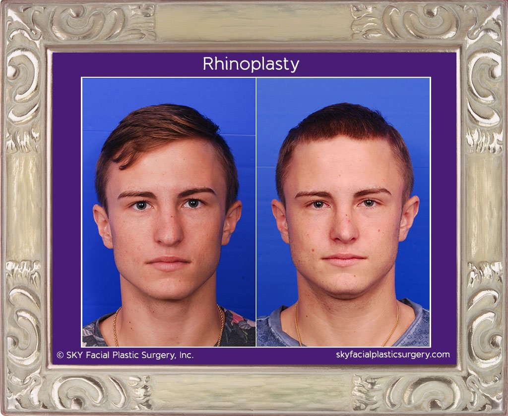 SKY-Facial-Plastic-Surgery-Rhinoplasty-18A.jpg