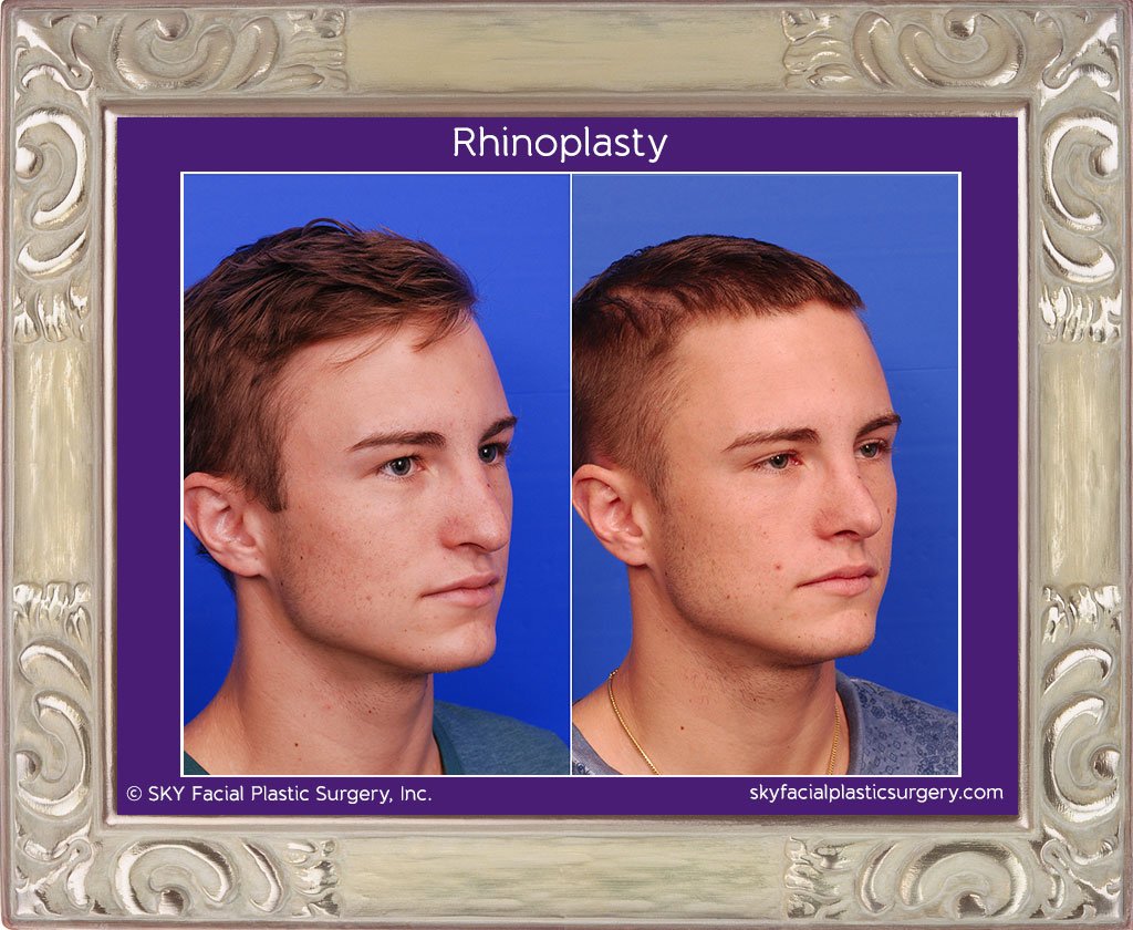 SKY-Facial-Plastic-Surgery-Rhinoplasty-18D.jpg