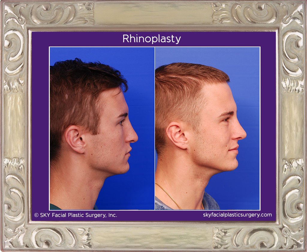 SKY-Facial-Plastic-Surgery-Rhinoplasty-18E.jpg