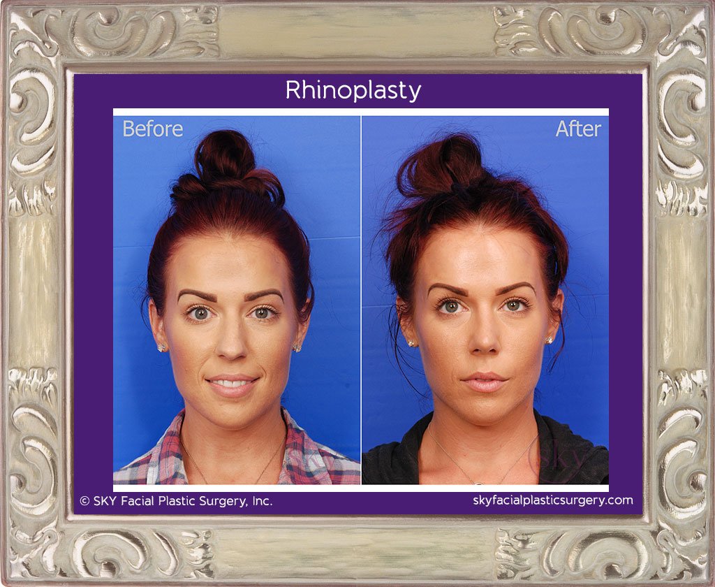 SKY-Facial-Plastic-Surgery-Rhinoplasty-19A.jpg