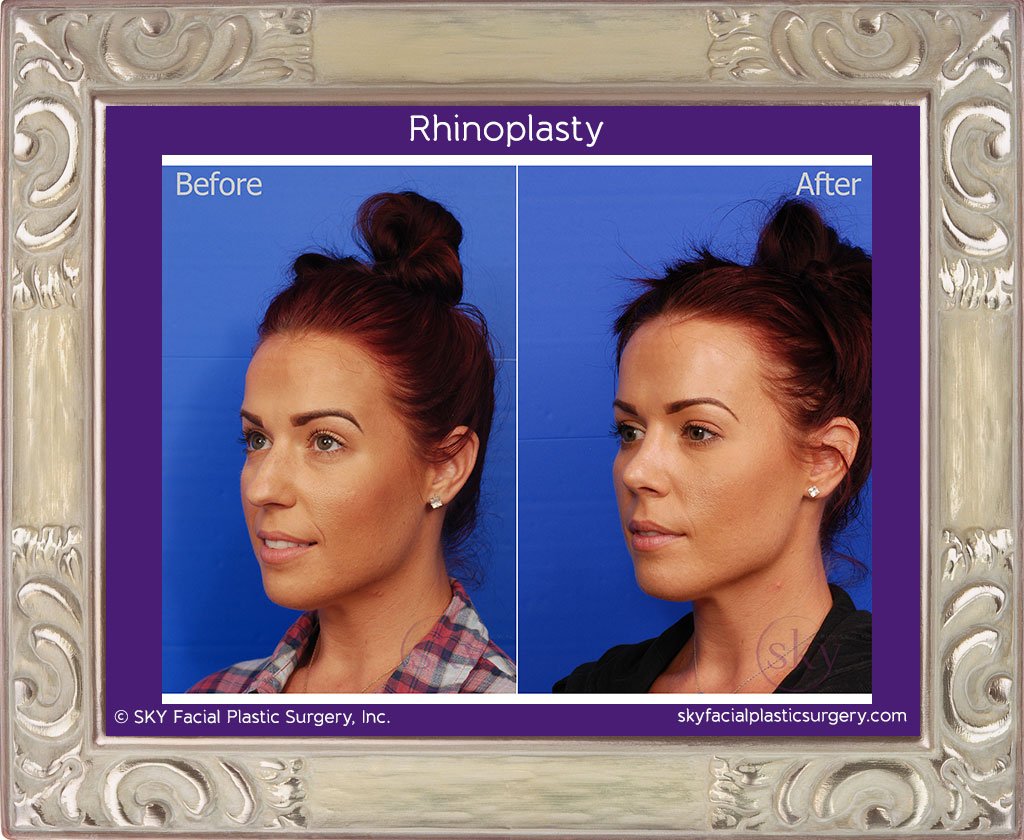 SKY-Facial-Plastic-Surgery-Rhinoplasty-19C.jpg