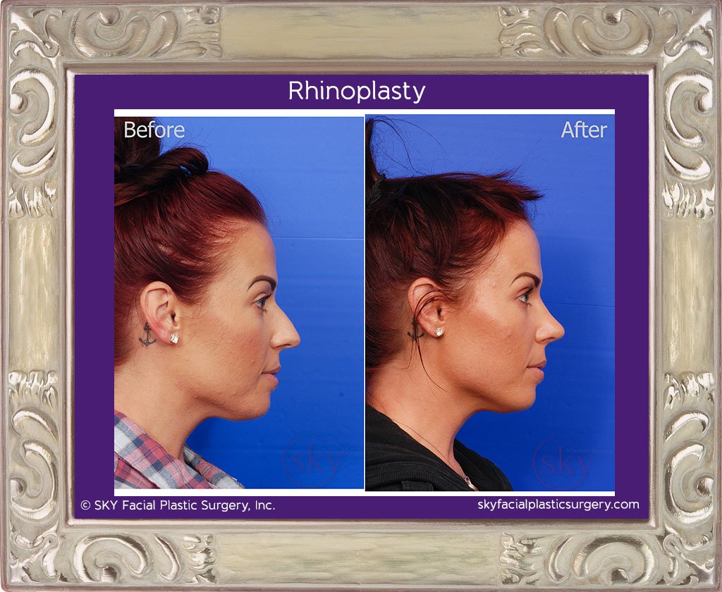 SKY-Facial-Plastic-Surgery-Rhinoplasty-19D.jpg