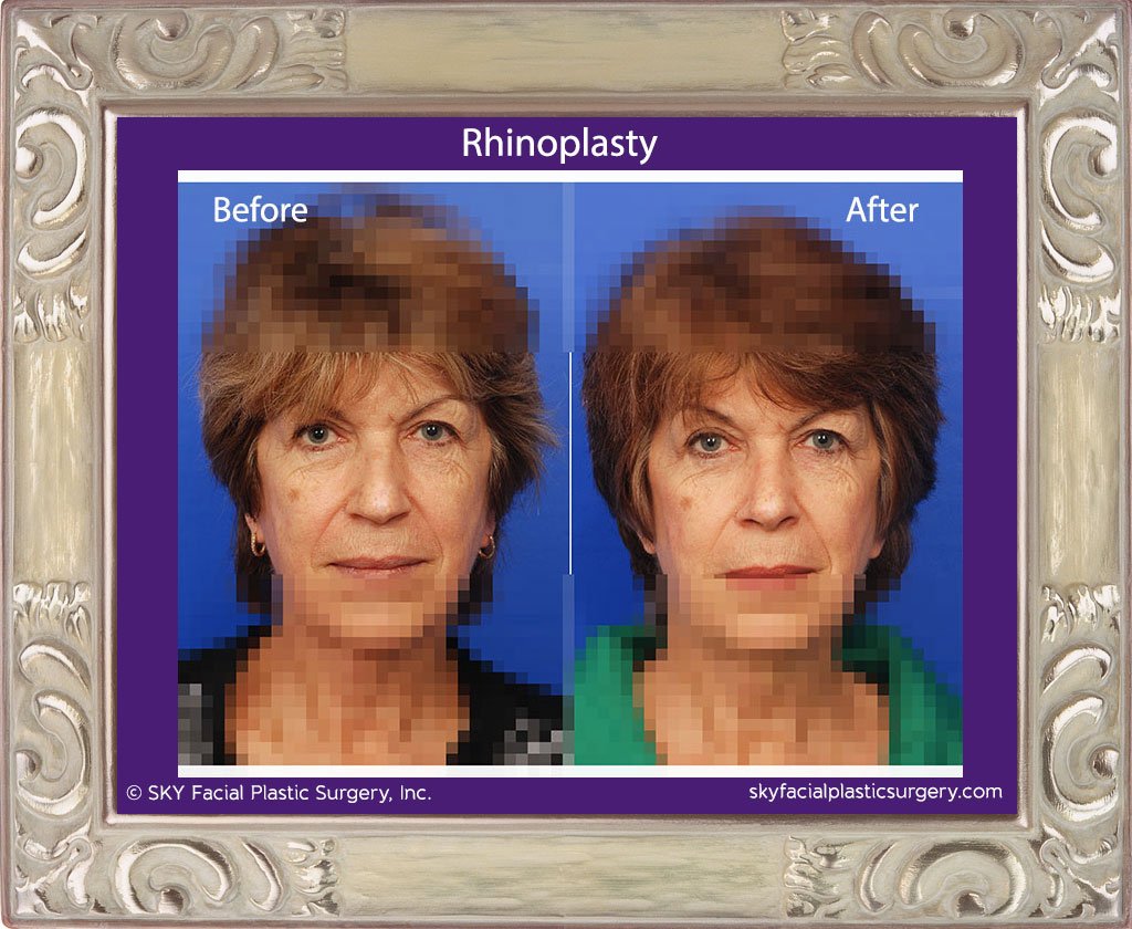 SKY-Facial-Plastic-Surgery-Rhinoplasty-20A.jpg