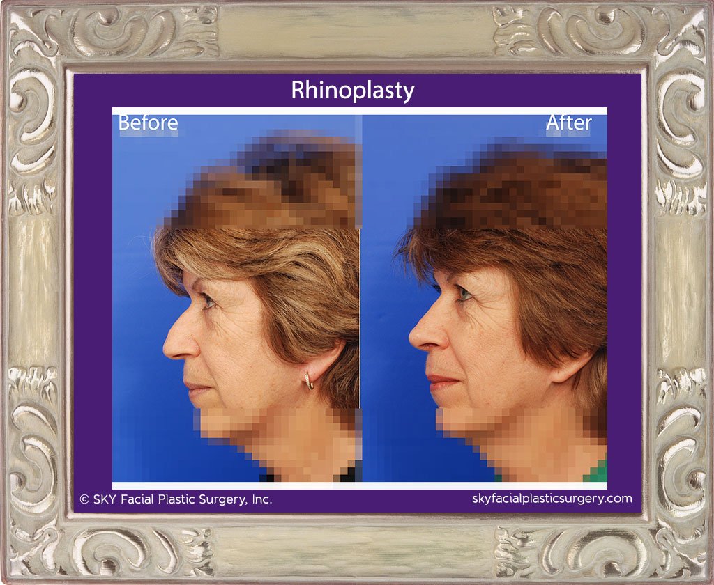 SKY-Facial-Plastic-Surgery-Rhinoplasty-20B.jpg