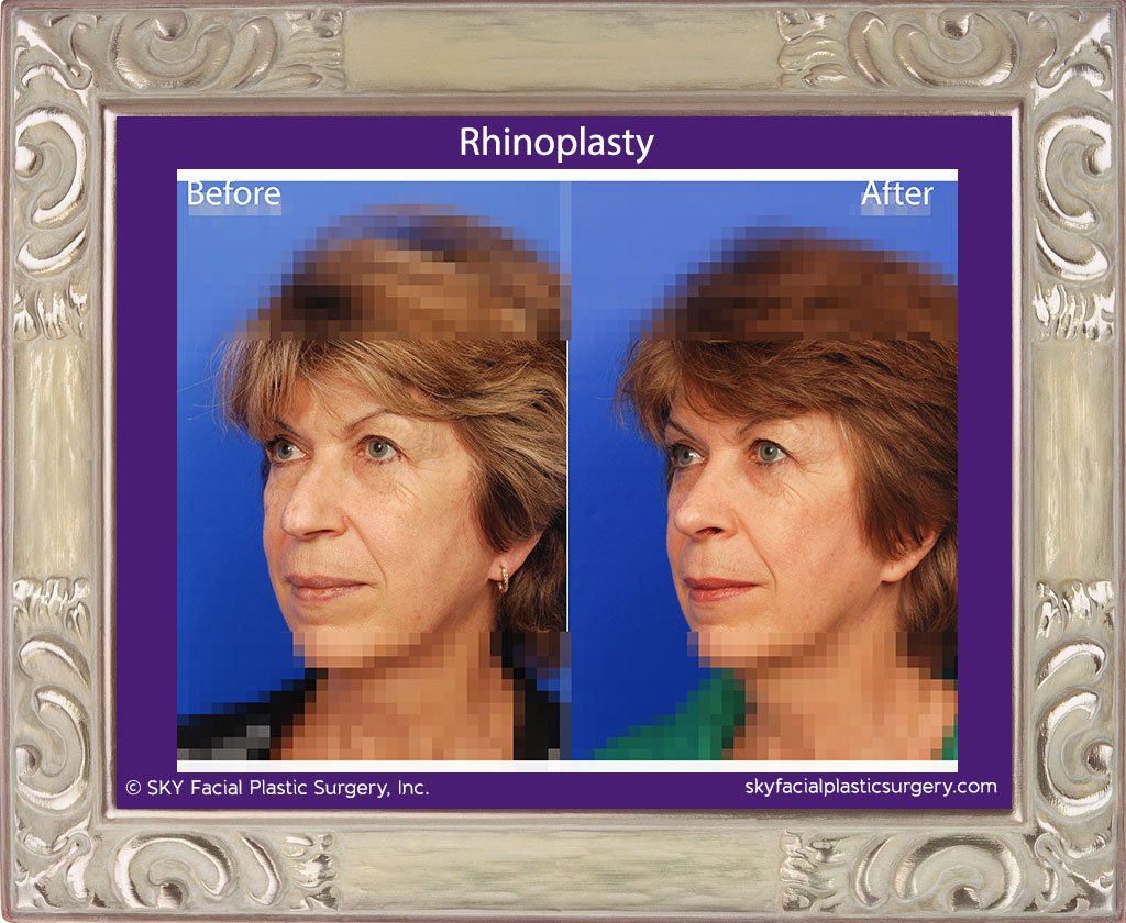 SKY-Facial-Plastic-Surgery-Rhinoplasty-20C.jpg