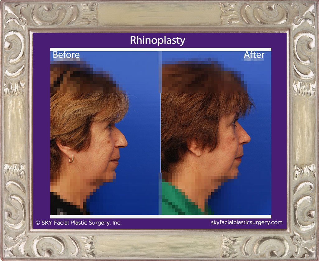SKY-Facial-Plastic-Surgery-Rhinoplasty-20E.jpg