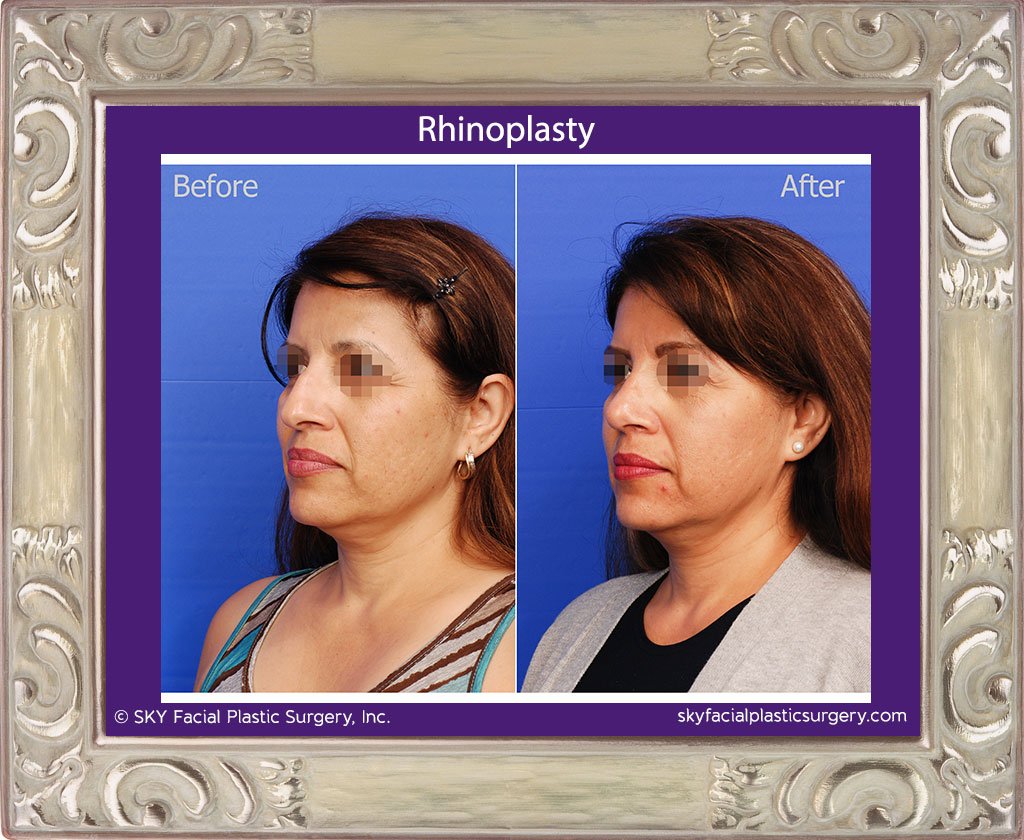 SKY-Facial-Plastic-Surgery-Rhinoplasty-21B.jpg