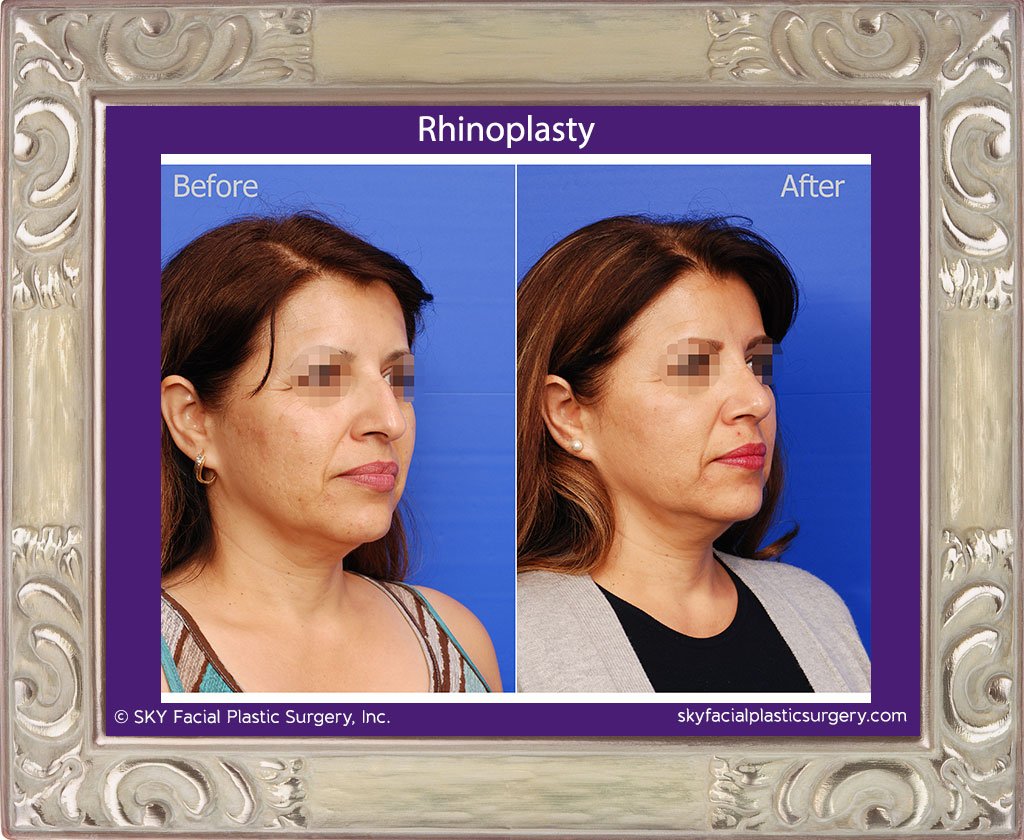 SKY-Facial-Plastic-Surgery-Rhinoplasty-21C.jpg