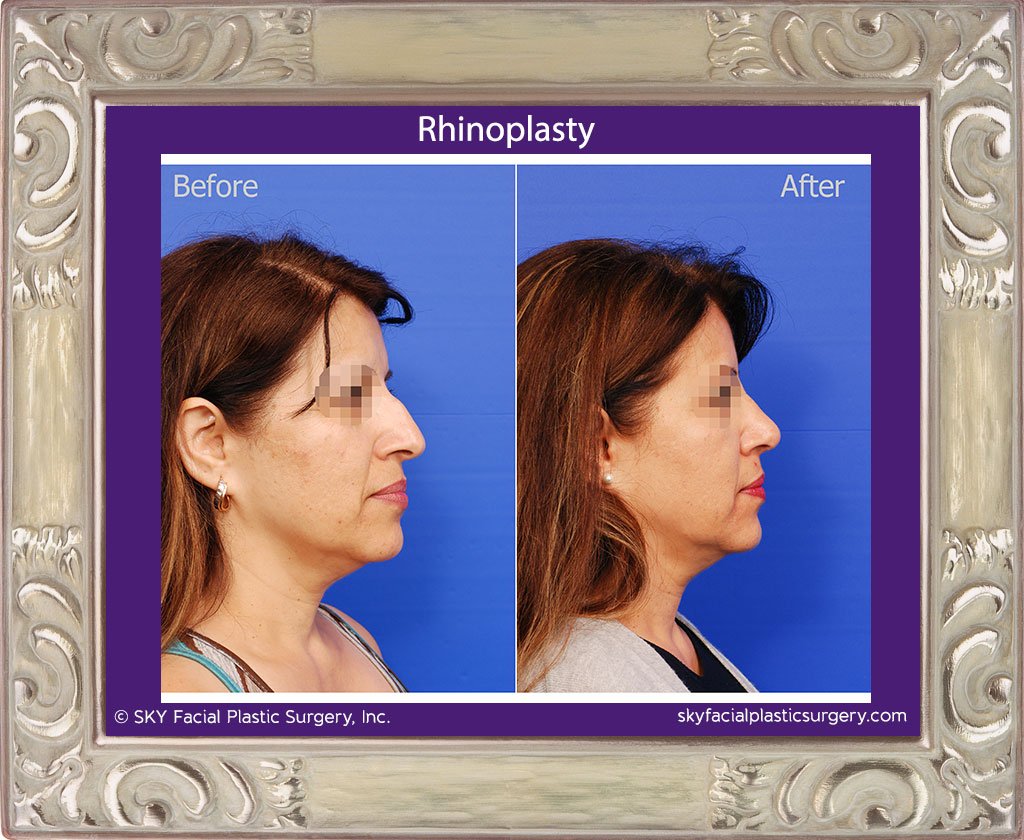SKY-Facial-Plastic-Surgery-Rhinoplasty-21D.jpg