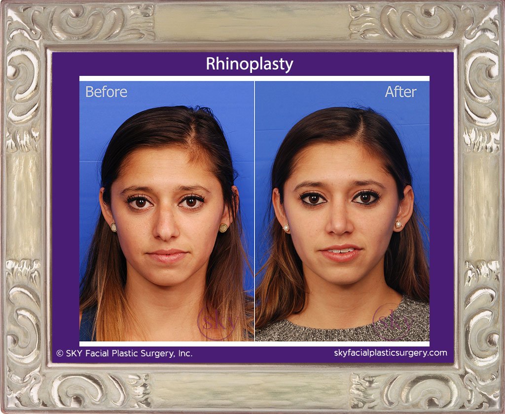 SKY-Facial-Plastic-Surgery-Rhinoplasty-22A.jpg