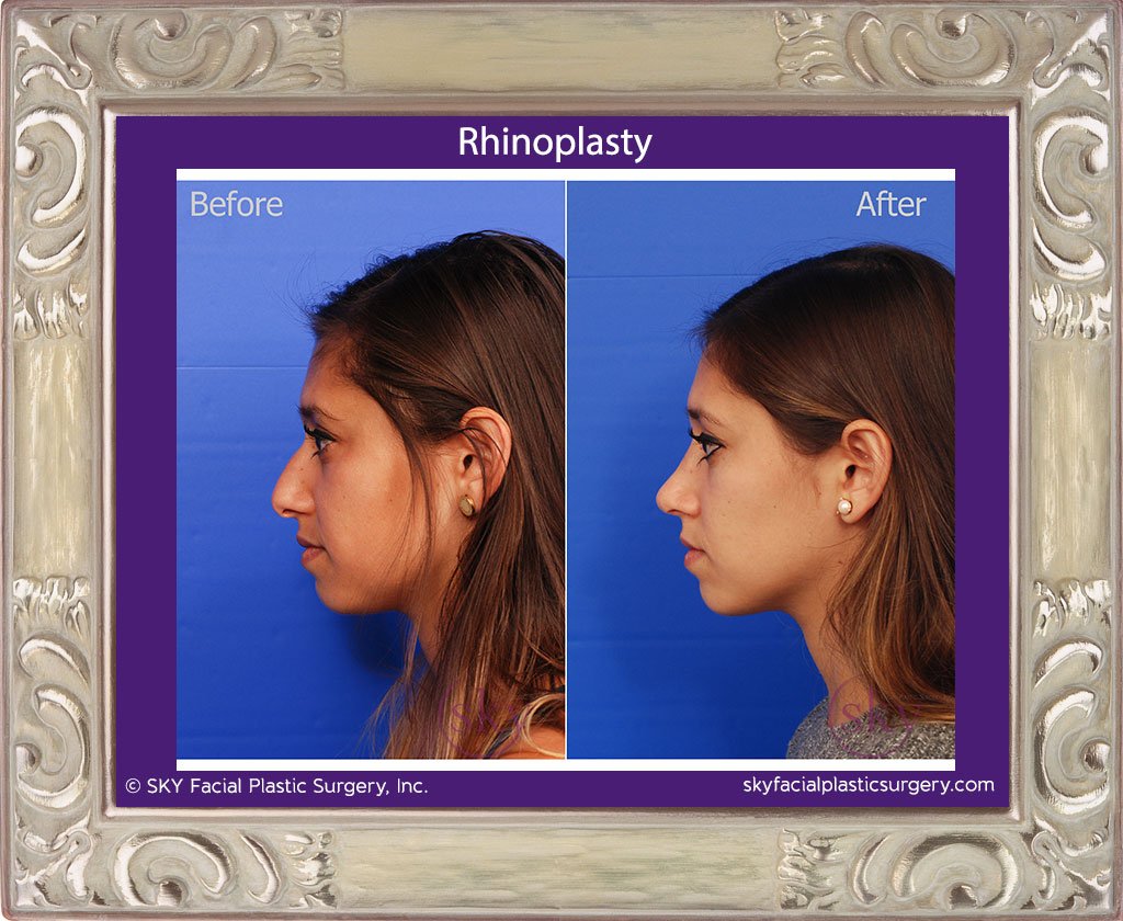 SKY-Facial-Plastic-Surgery-Rhinoplasty-22B.jpg