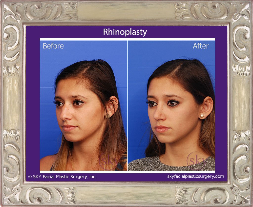 SKY-Facial-Plastic-Surgery-Rhinoplasty-22C.jpg