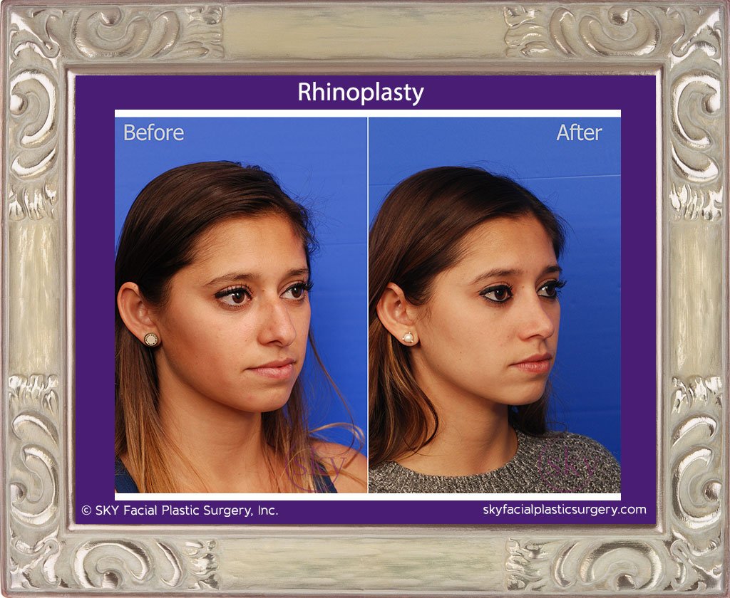 SKY-Facial-Plastic-Surgery-Rhinoplasty-22D.jpg