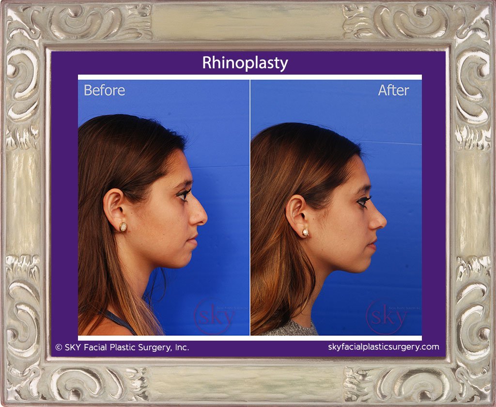 SKY-Facial-Plastic-Surgery-Rhinoplasty-22E.jpg