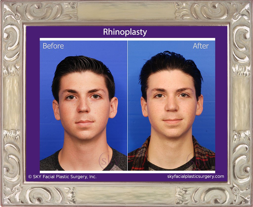 SKY-Facial-Plastic-Surgery-Rhinoplasty-23A.jpg
