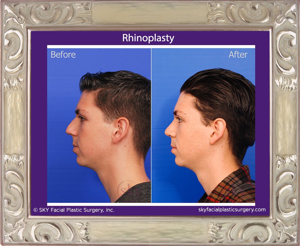 SKY-Facial-Plastic-Surgery-Rhinoplasty-23B.jpg