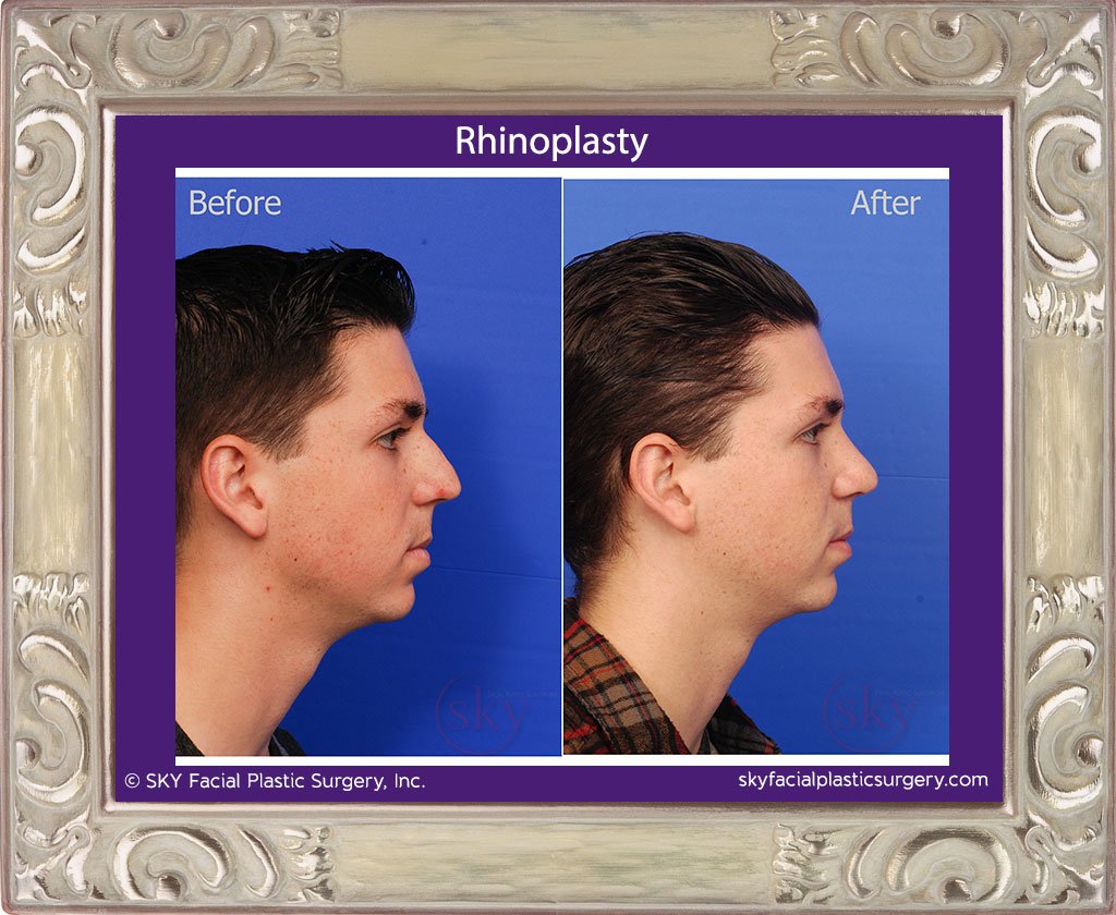 SKY-Facial-Plastic-Surgery-Rhinoplasty-23D.jpg