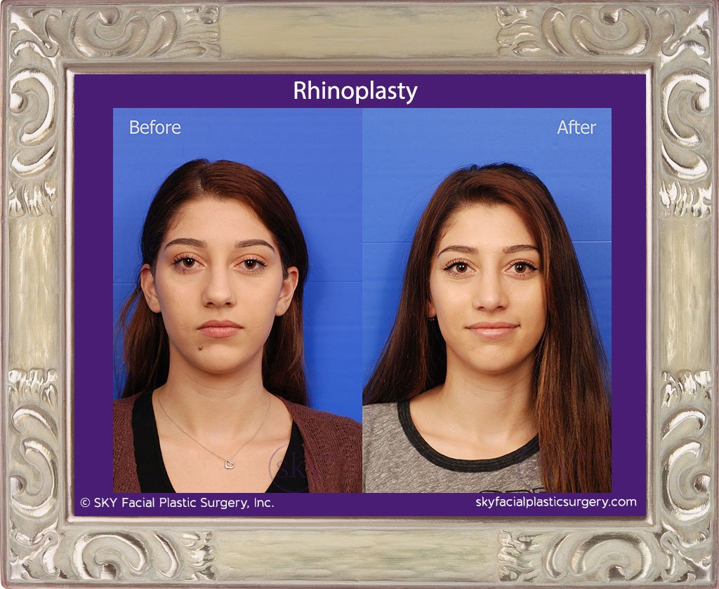 SKY-Facial-Plastic-Surgery-Rhinoplasty-24A.jpg