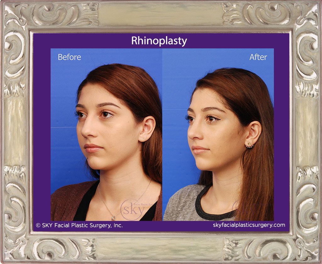 SKY-Facial-Plastic-Surgery-Rhinoplasty-24B.jpg