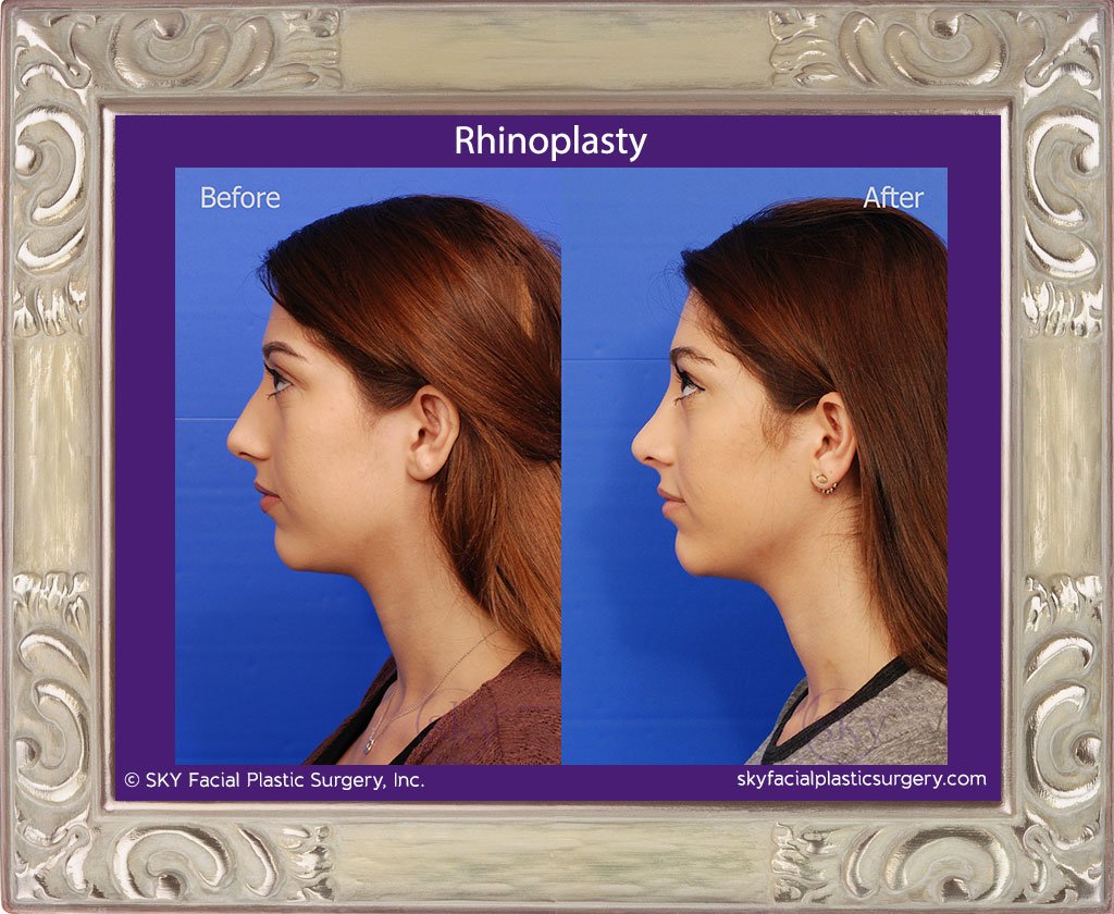 SKY-Facial-Plastic-Surgery-Rhinoplasty-24D.jpg