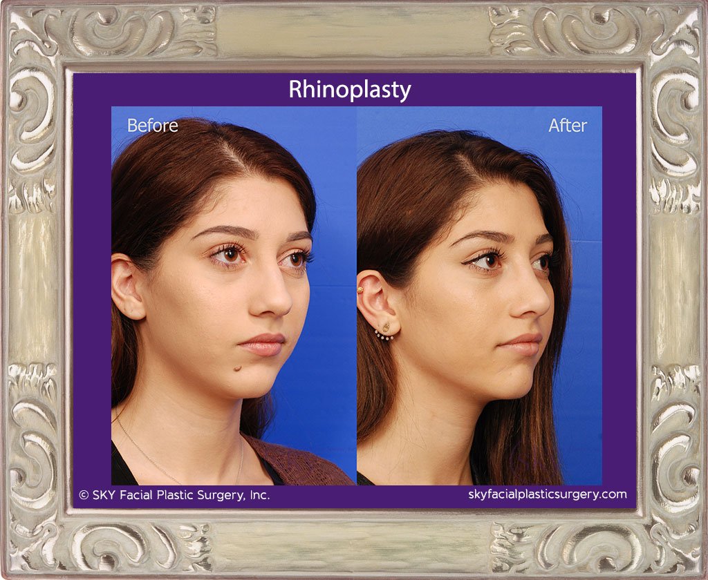 SKY-Facial-Plastic-Surgery-Rhinoplasty-24E.jpg