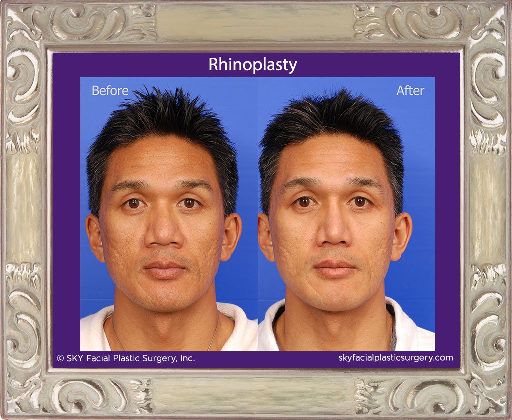 SKY-Facial-Plastic-Surgery-Rhinoplasty-26A.jpg