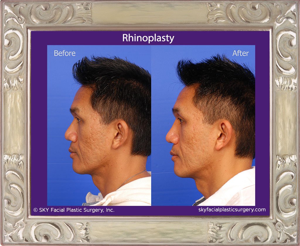 SKY-Facial-Plastic-Surgery-Rhinoplasty-26B.jpg