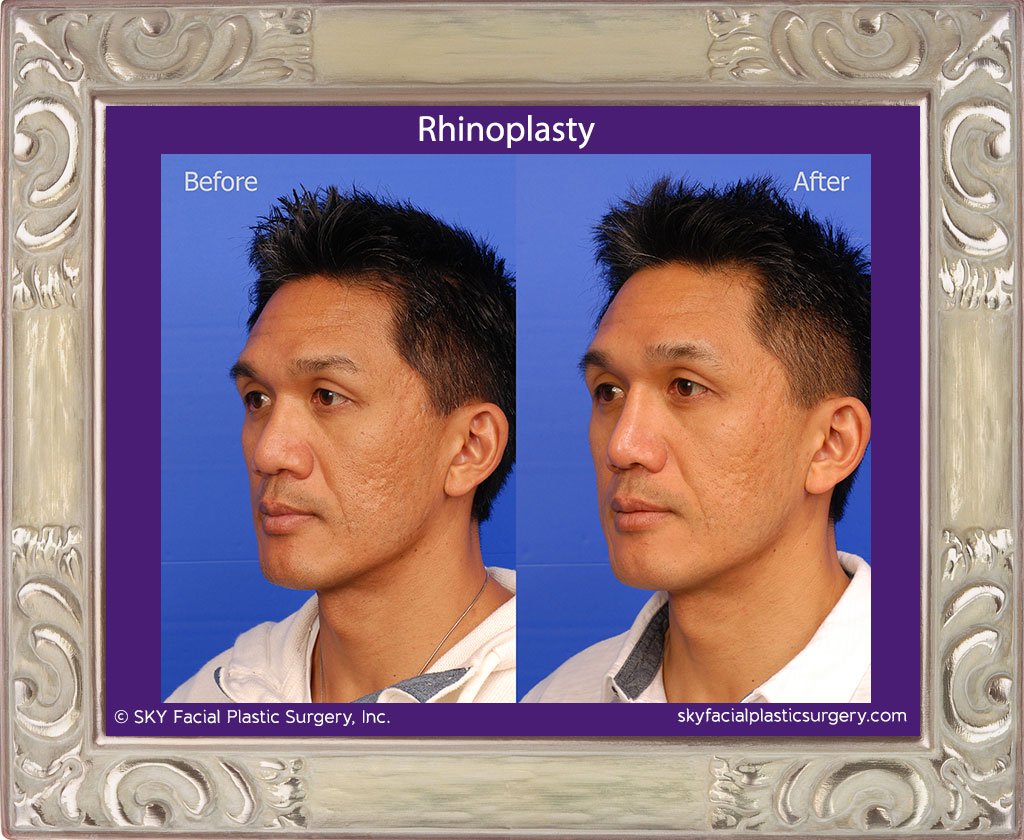 SKY-Facial-Plastic-Surgery-Rhinoplasty-26C.jpg