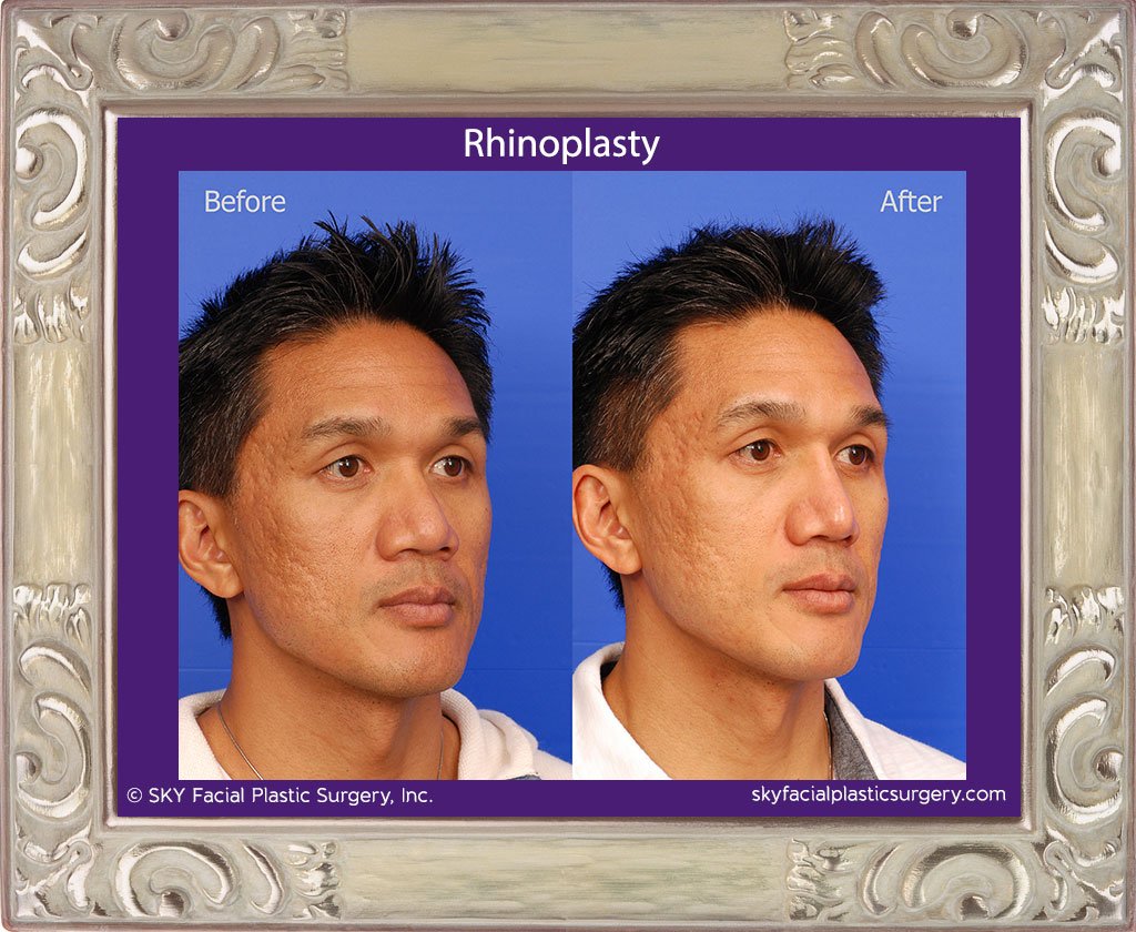SKY-Facial-Plastic-Surgery-Rhinoplasty-26D.jpg