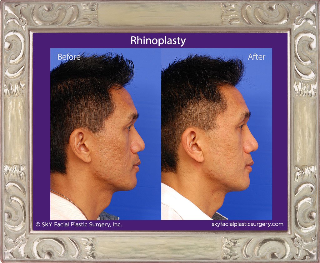 SKY-Facial-Plastic-Surgery-Rhinoplasty-26E.jpg