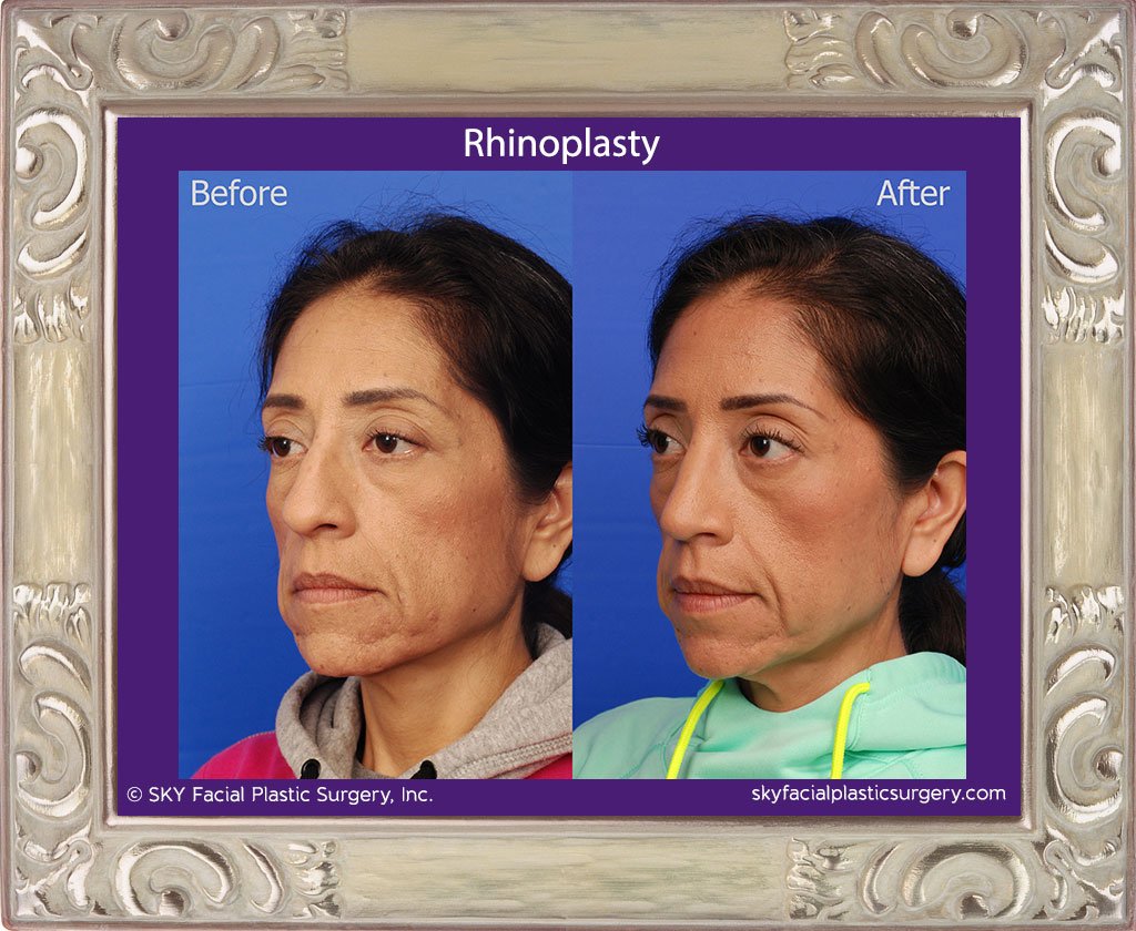 SKY-Facial-Plastic-Surgery-Rhinoplasty-27C.jpg