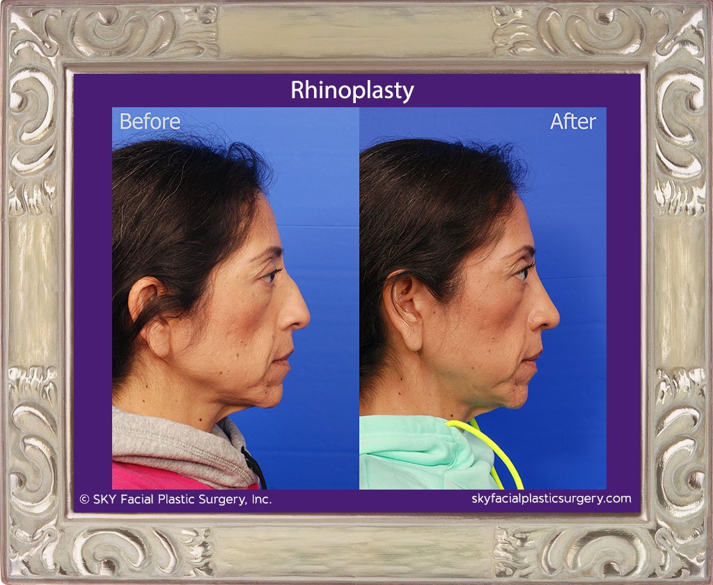 SKY-Facial-Plastic-Surgery-Rhinoplasty-27D.jpg