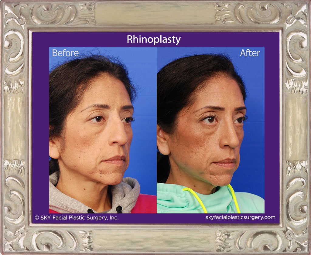 SKY-Facial-Plastic-Surgery-Rhinoplasty-27E.jpg