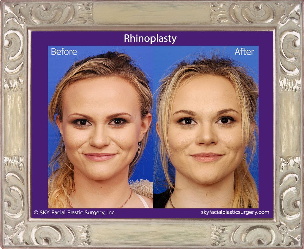 SKY-Facial-Plastic-Surgery-Rhinoplasty-28A.jpg