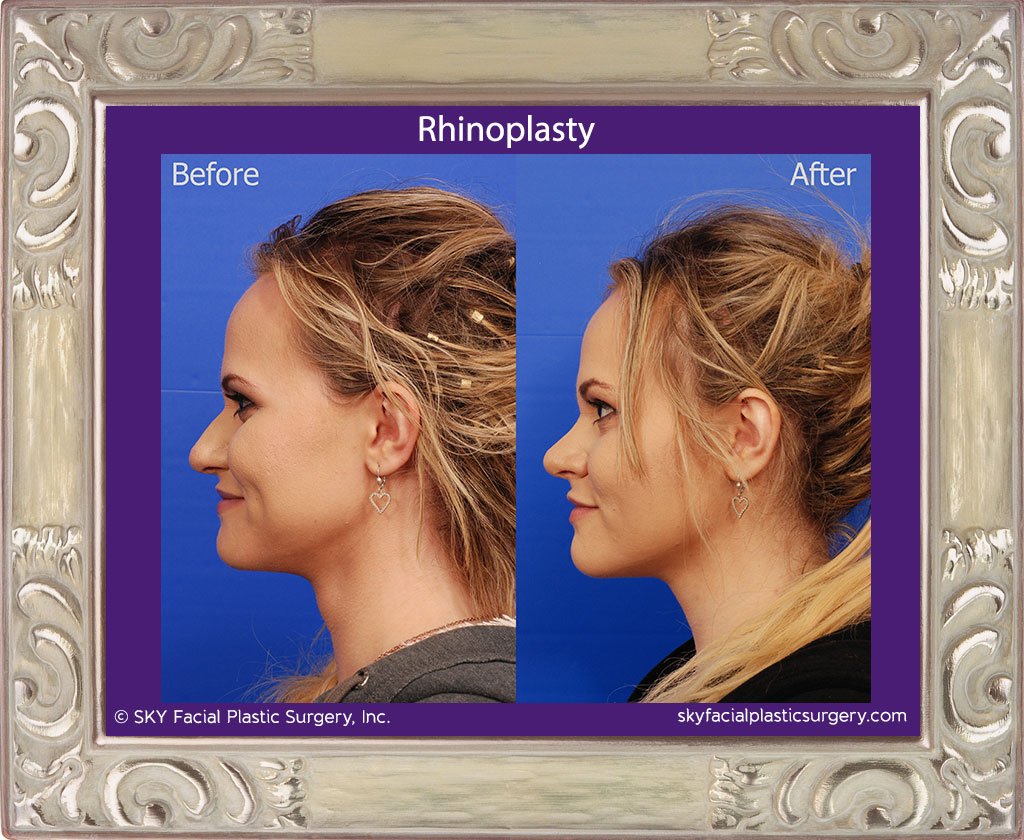 SKY-Facial-Plastic-Surgery-Rhinoplasty-28B.jpg