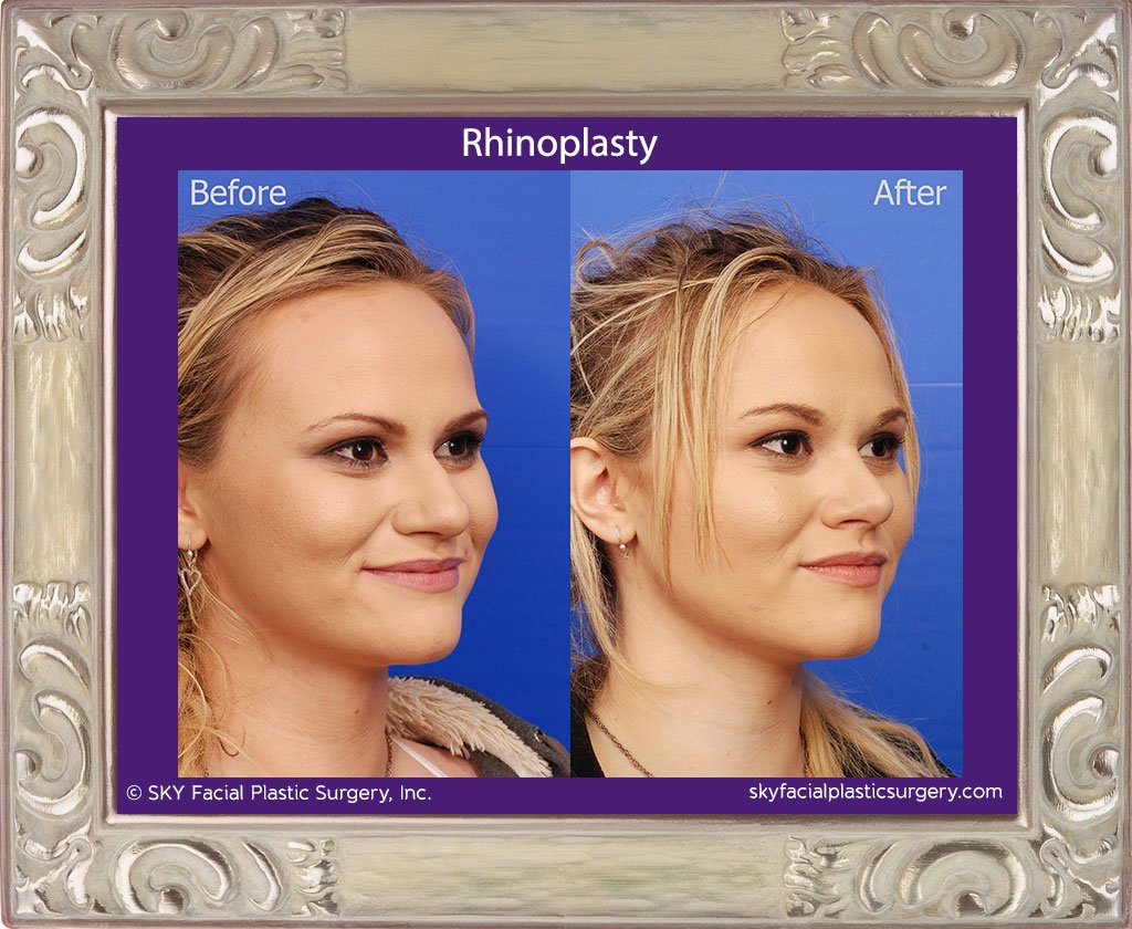 SKY-Facial-Plastic-Surgery-Rhinoplasty-28D.jpg