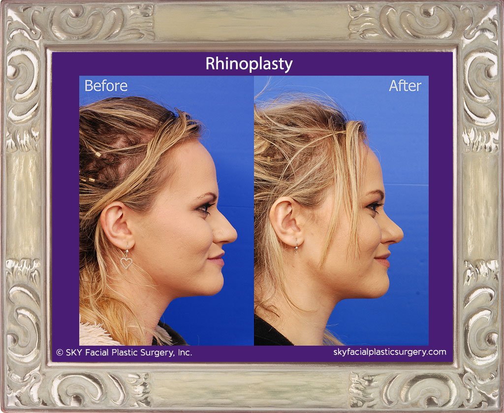 SKY-Facial-Plastic-Surgery-Rhinoplasty-28E.jpg