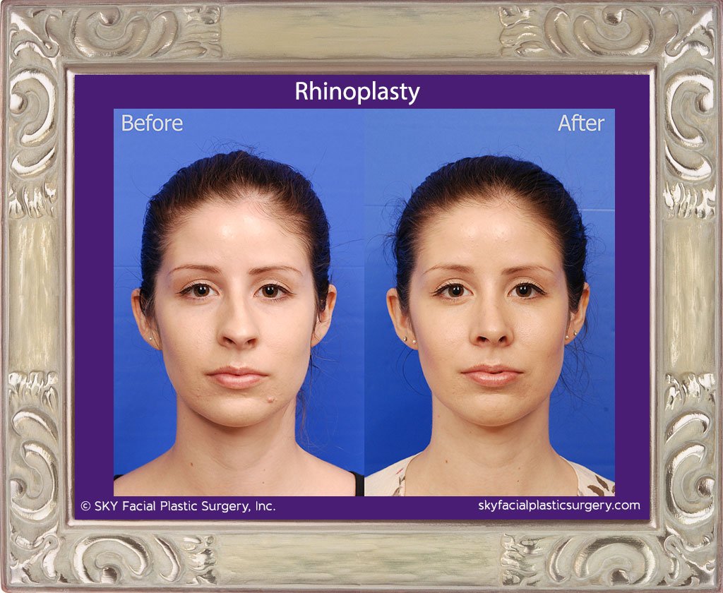 SKY-Facial-Plastic-Surgery-Rhinoplasty-29A.jpg