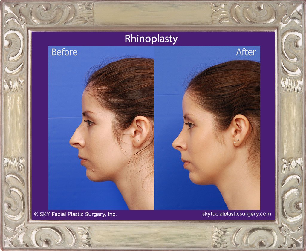 SKY-Facial-Plastic-Surgery-Rhinoplasty-29B.jpg
