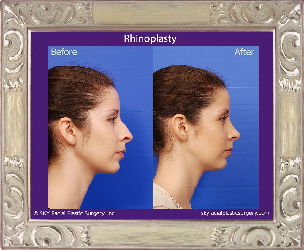 SKY-Facial-Plastic-Surgery-Rhinoplasty-29E.jpg