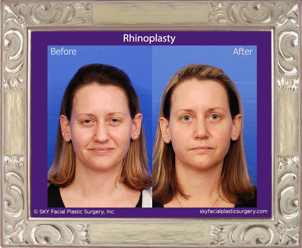 SKY-Facial-Plastic-Surgery-Rhinoplasty-30A.jpg