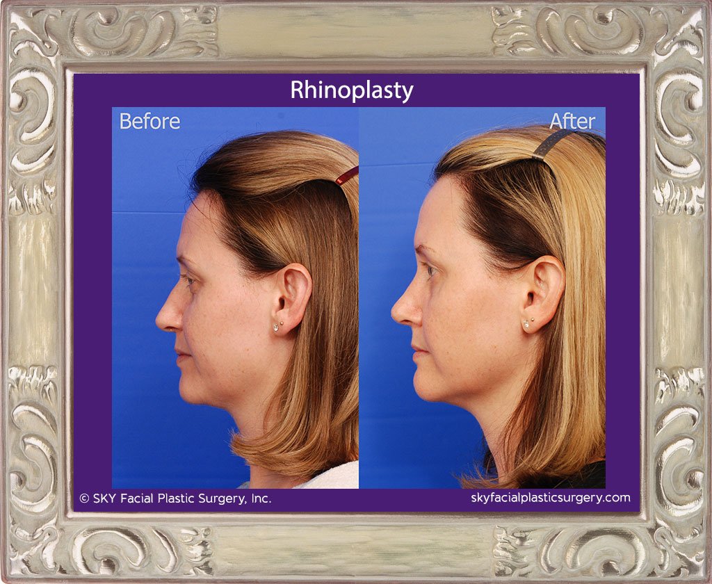 SKY-Facial-Plastic-Surgery-Rhinoplasty-30B.jpg