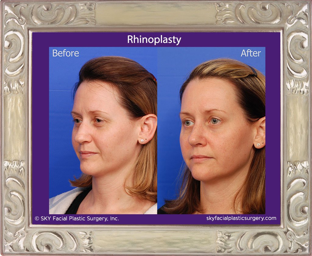 SKY-Facial-Plastic-Surgery-Rhinoplasty-30C.jpg