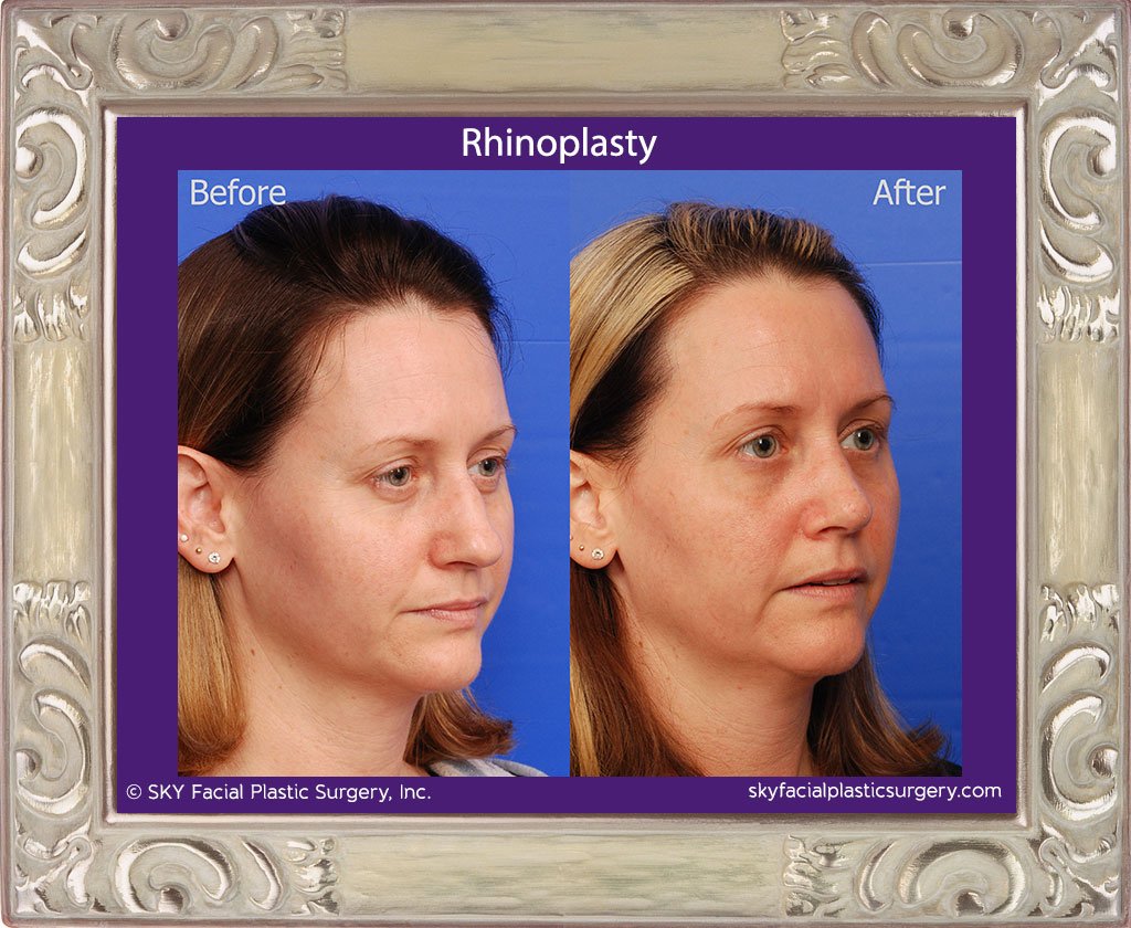 SKY-Facial-Plastic-Surgery-Rhinoplasty-30D.jpg